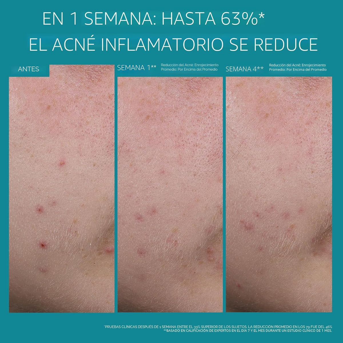 La Roche-Posay Effaclar BPO Multi-Target Acne Treatment, Benzoyl Pe...